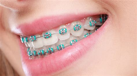 metal brackets in orthodontics|best metal braces for teeth.